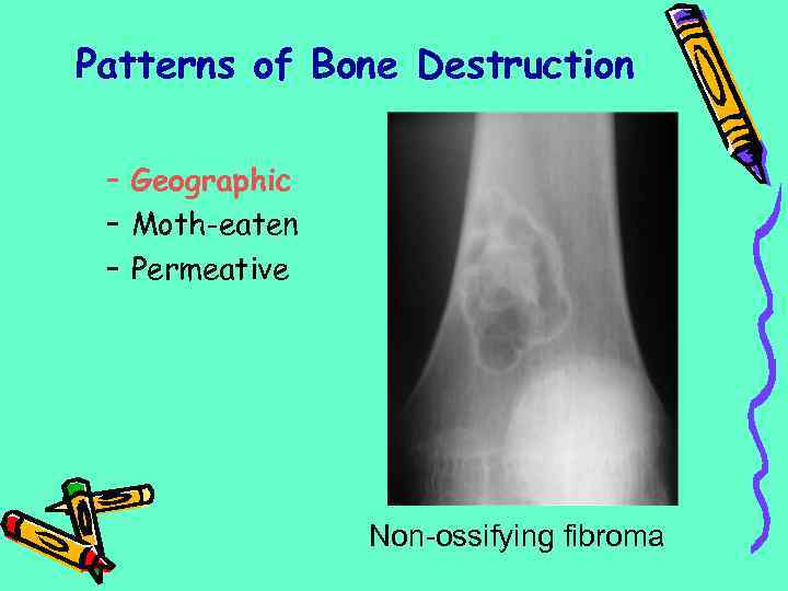 Patterns of Bone Destruction – Geographic – Moth-eaten – Permeative Non-ossifying fibroma 