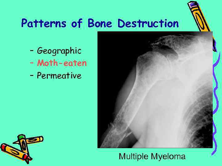 Patterns of Bone Destruction – Geographic – Moth-eaten – Permeative Multiple Myeloma 