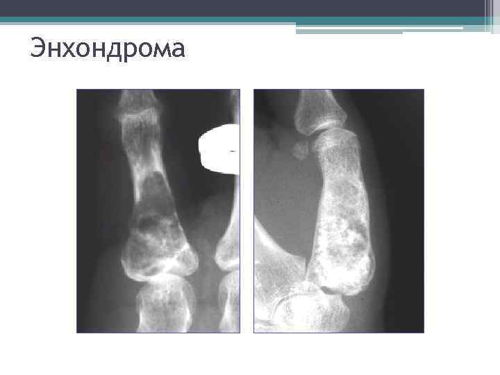 Опухоли костей презентация