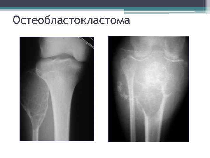 Для рентгенологической картины кистозной формы гигантоклеточной опухоли характерно