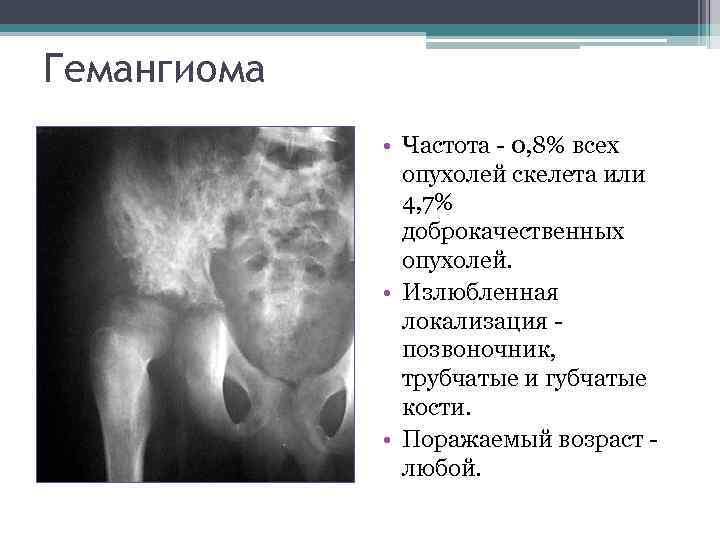 Гемангиома • Частота - 0, 8% всех опухолей скелета или 4, 7% доброкачественных опухолей.