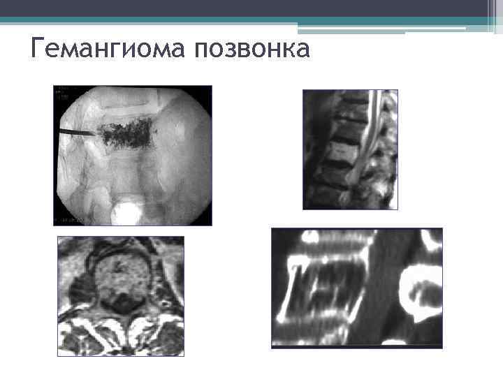 Гемангиома позвонка 