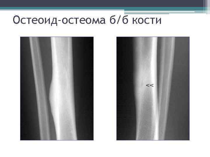 Остеоид-остеома б/б кости 