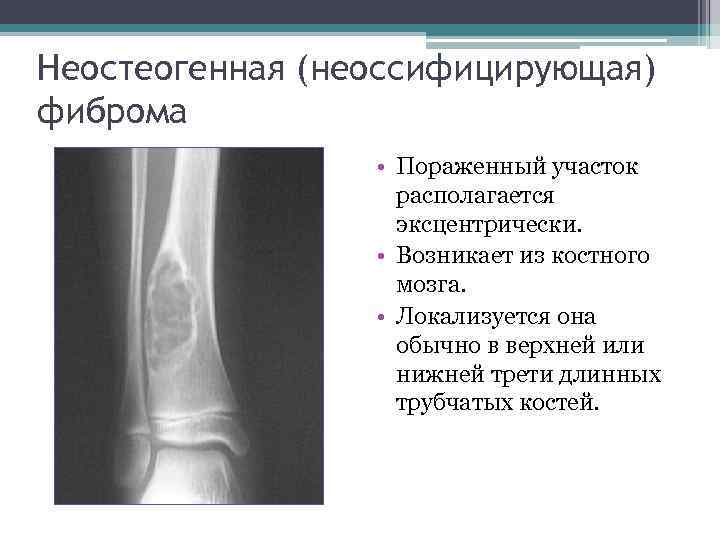 Неостеогенная (неоссифицирующая) фиброма • Пораженный участок располагается эксцентрически. • Возникает из костного мозга. •