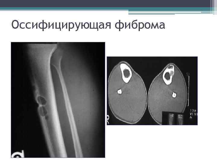 Оссифицирующая фиброма 
