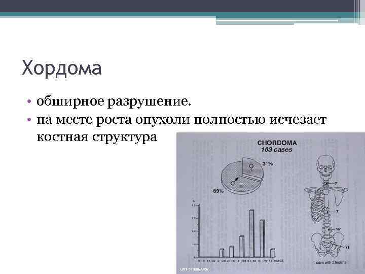 Хордома • обширное разрушение. • на месте роста опухоли полностью исчезает костная структура 