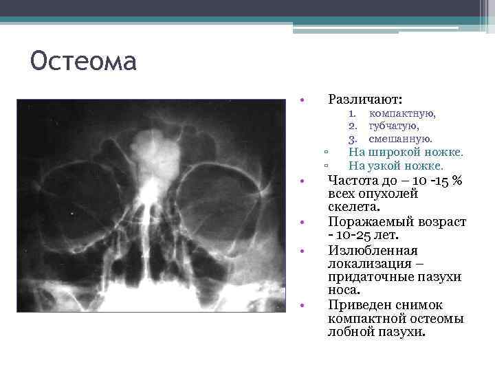 Остеома • • • Различают: ▫ ▫ 1. компактную, 2. губчатую, 3. смешанную. На