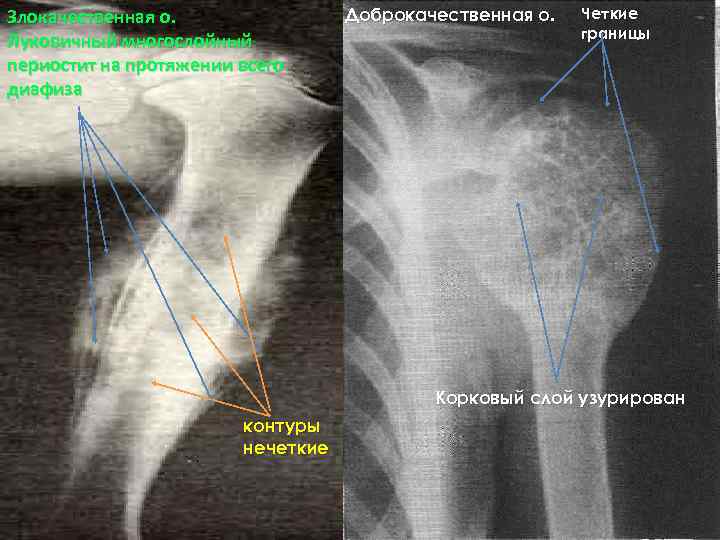 Злокачественная о. Луковичный многослойный периостит на протяжении всего диафиза Доброкачественная о. Четкие границы Корковый