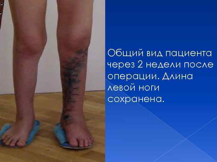 Общий вид пациента через 2 недели после операции. Длина левой ноги сохранена. 