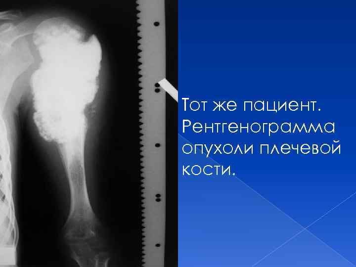 Тот же пациент. Рентгенограмма опухоли плечевой кости. 