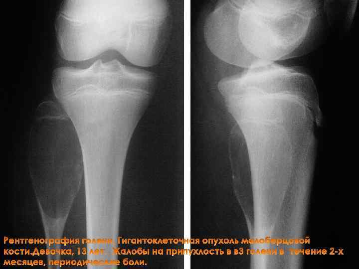 Рентгенография голени. Гигантоклеточная опухоль малоберцовой кости. Девочка, 13 лет. Жалобы на припухлость в в