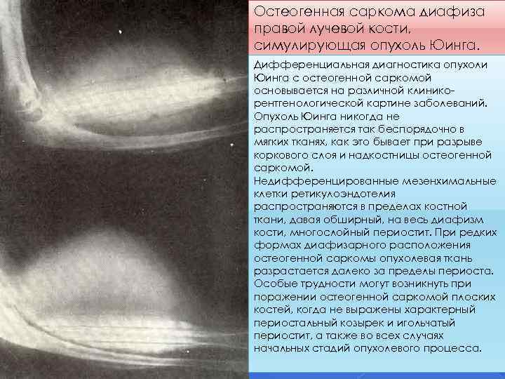 Остеогенная саркома диафиза правой лучевой кости, симулирующая опухоль Юинга. Дифференциальная диагностика опухоли Юинга с