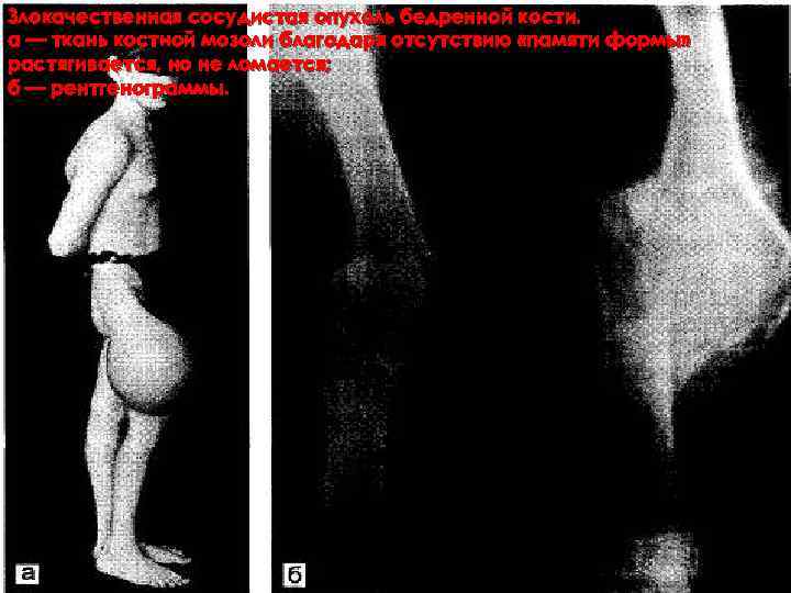 Злокачественная сосудистая опухоль бедренной кости. а — ткань костной мозоли благодаря отсутствию «памяти формы»