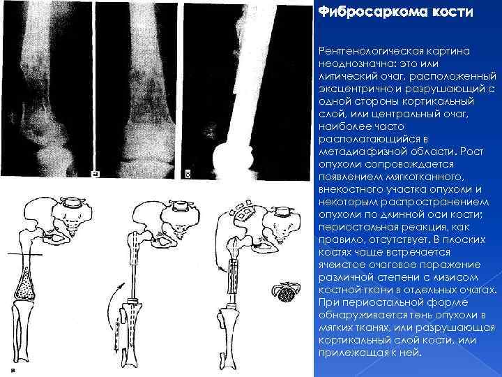 Неоднозначно это. Кортикальные опухоли костей. Литические опухоли костей. Кортикальный слой бедренной кости. Кортикальный слой кости разрушение причины.