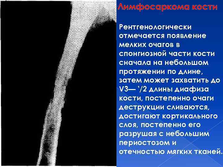 Лимфосаркома кости Рентгенологически отмечается появление мелких очагов в спонгиозной части кости сначала на небольшом