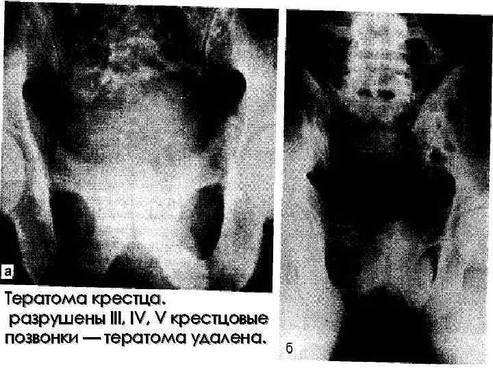 Тератома крестца. разрушены III, IV, V крестцовые позвонки — тератома удалена. 