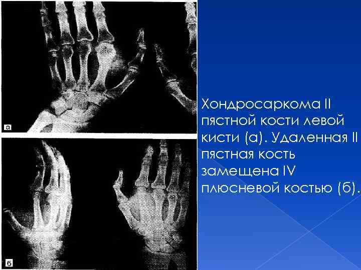 Хондросаркома II пястной кости левой кисти (а). Удаленная II пястная кость замещена IV плюсневой