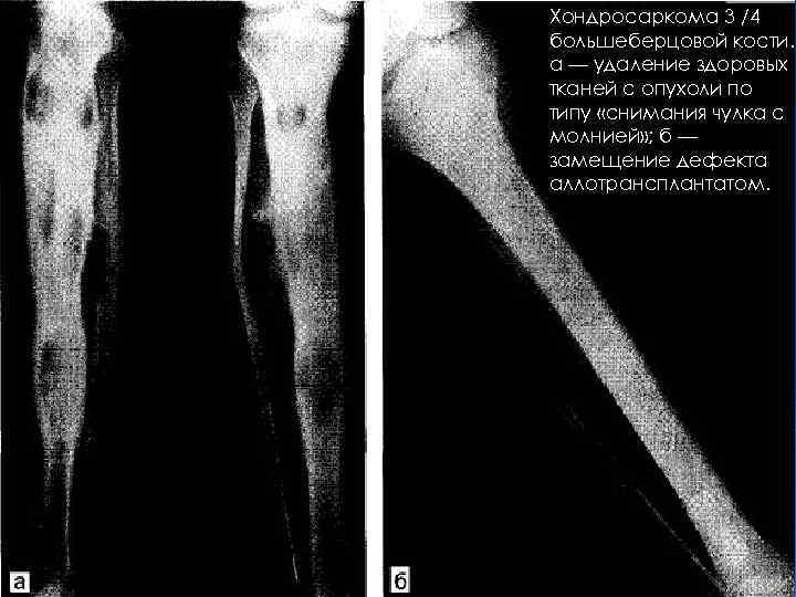 Хондросаркома 3 /4 большеберцовой кости. а — удаление здоровых тканей с опухоли по типу