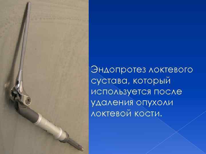 Эндопротез локтевого сустава, который используется после удаления опухоли локтевой кости. 