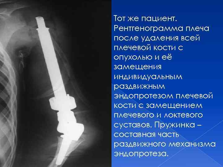 Тот же пациент. Рентгенограмма плеча после удаления всей плечевой кости с опухолью и её