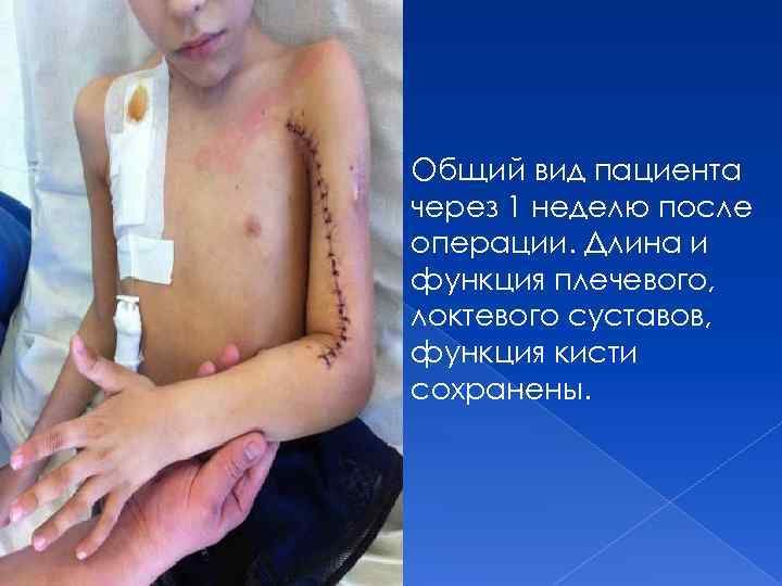 Общий вид пациента через 1 неделю после операции. Длина и функция плечевого, локтевого суставов,