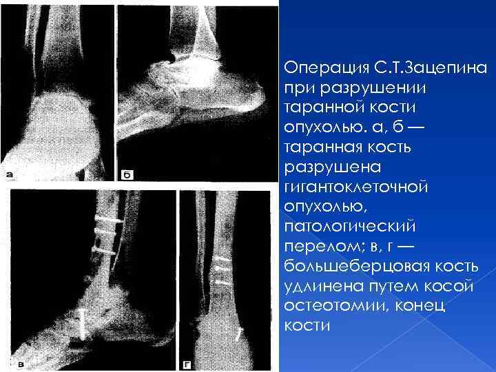 Операция С. Т. Зацепина при разрушении таранной кости опухолью. а, б — таранная кость