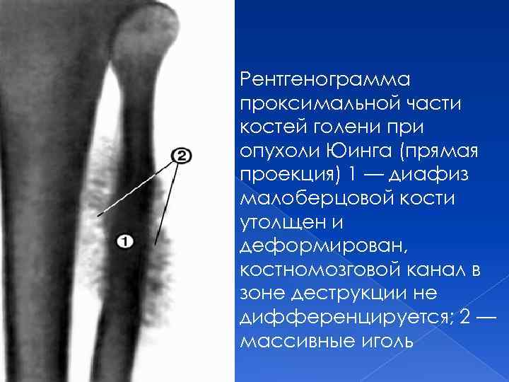 Диафиза большеберцовой кости фото