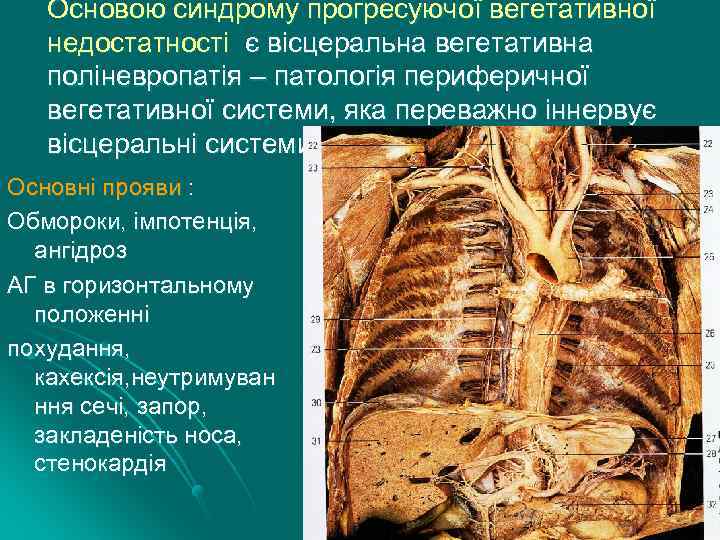 Основою синдрому прогресуючої вегетативної недостатності є вісцеральна вегетативна поліневропатія – патологія периферичної вегетативної системи,