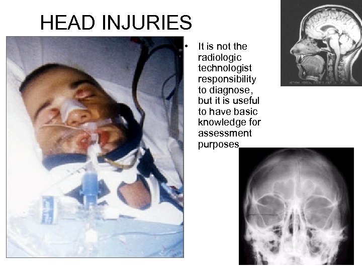 HEAD INJURIES • It is not the radiologic technologist responsibility to diagnose, but it