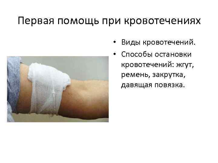 Первая помощь при кровотечениях • Виды кровотечений. • Способы остановки кровотечений: жгут, ремень, закрутка,
