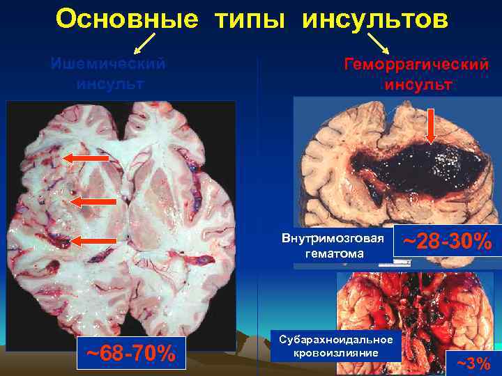 Основные типы инсультов Ишемический инсульт Геморрагический инсульт Внутримозговая гематома ~68 -70% Субарахноидальное кровоизлияние ~28