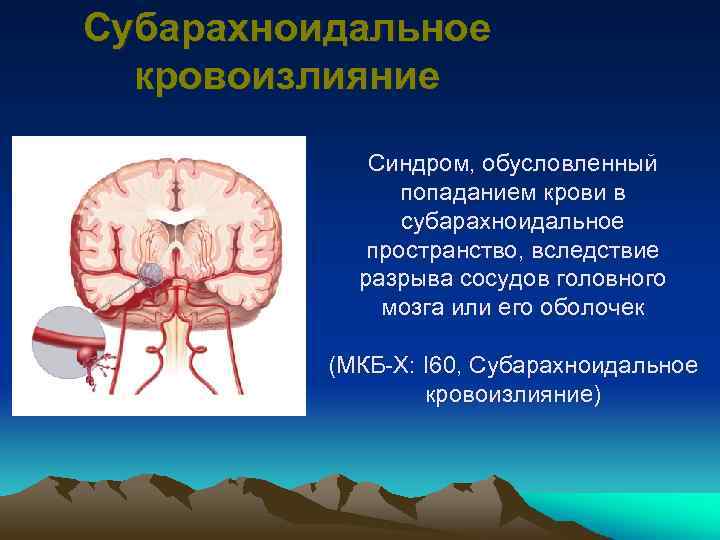 Субарахноидальное кровоизлияние Синдром, обусловленный попаданием крови в субарахноидальное пространство, вследствие разрыва сосудов головного мозга