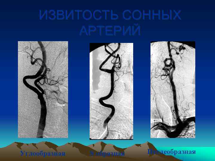 ИЗВИТОСТЬ СОННЫХ АРТЕРИЙ Углообразная S образная Петлеобразная 