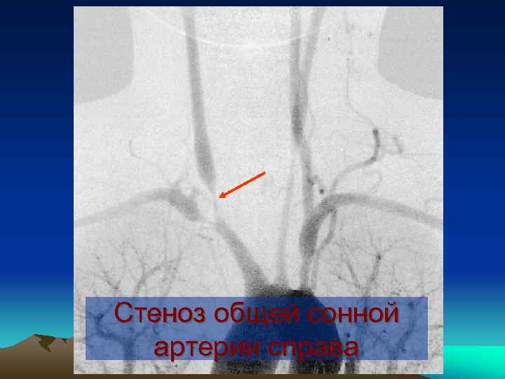 Стеноз общей сонной артерии справа 