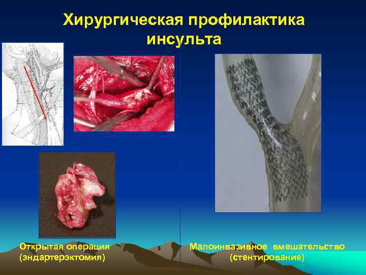 Хирургическая профилактика инсульта Открытая операция (эндартерэктомия) Малоинвазивное вмешательство (стентирование) 