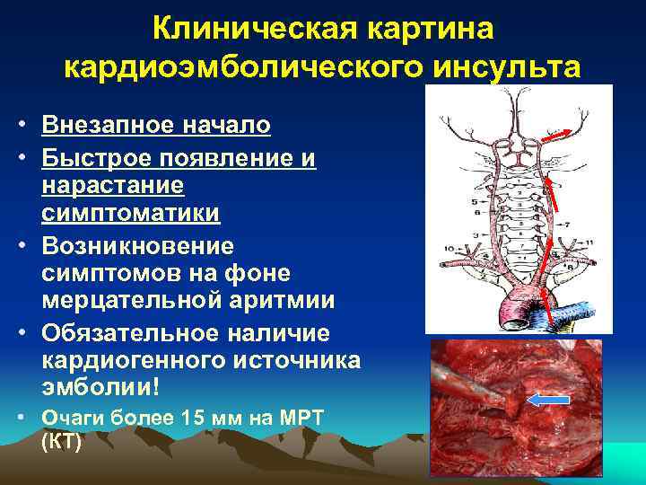 Поражение сосудов мозга