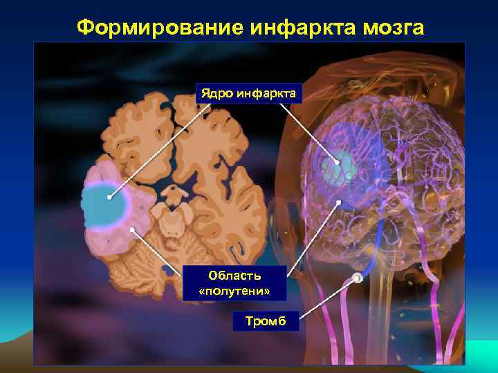 Формирование инфаркта мозга Ядро инфаркта Область «полутени» Тромб 