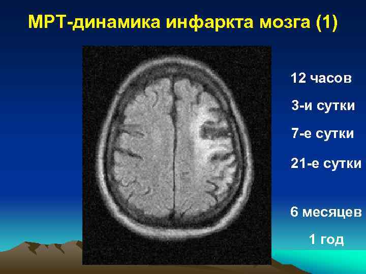 МРТ-динамика инфаркта мозга (1) 12 часов 3 -и сутки 7 -е сутки 21 -е