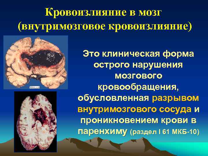 Кровоизлияние в мозг (внутримозговое кровоизлияние) Это клиническая форма острого нарушения мозгового кровообращения, обусловленная разрывом