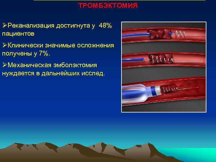 ТРОМБЭКТОМИЯ ØРеканализация достигнута у 48% пациентов ØКлинически значимые осложнения получены у 7%. ØМеханическая эмболэктомия