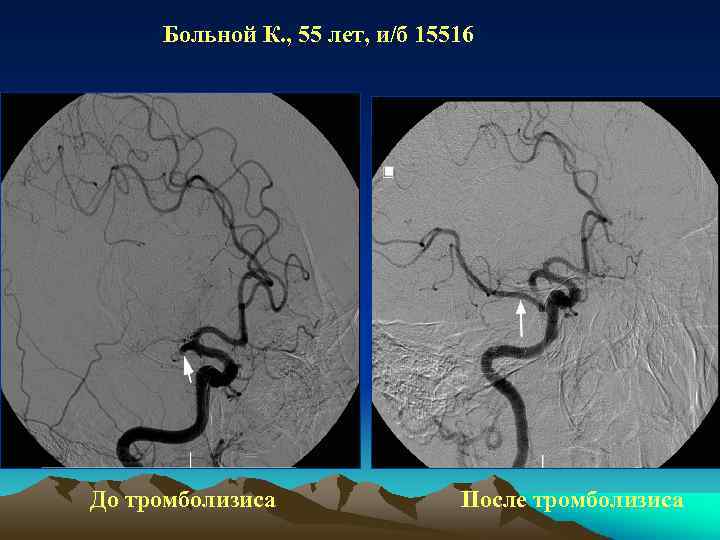 Больной К. , 55 лет, и/б 15516 До тромболизиса После тромболизиса 