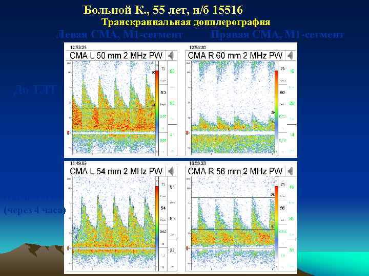 Больной К. , 55 лет, и/б 15516 Транскраниальная допплерография Левая СМА, М 1 -сегмент