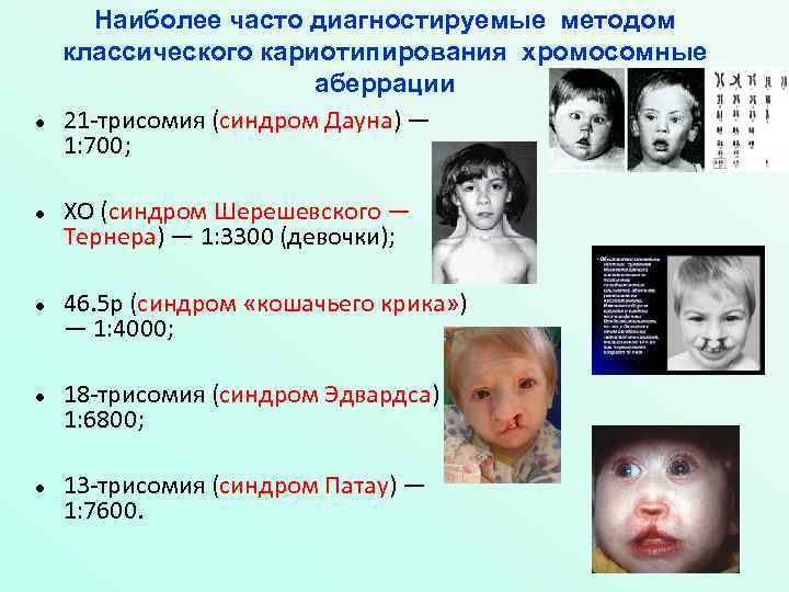  Наиболее часто диагностируемые методом классического кариотипирования хромосомные аберрации 21 -трисомия (синдром Дауна) —