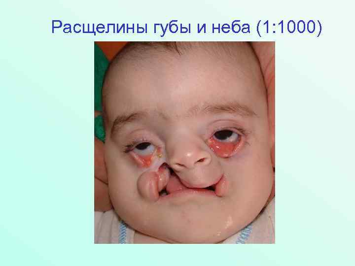 Расщелины губы и неба (1: 1000) 
