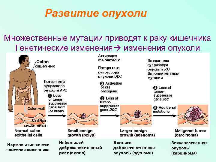 Развитие опухоли Множественные мутации приводят к раку кишечника Генетические изменения опухоли Активация ras онкогена