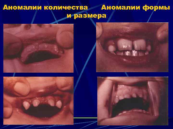 Аномалии количества Аномалии формы и размера 