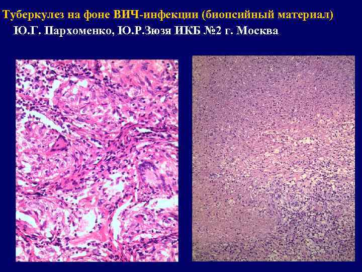 Туберкулез на фоне ВИЧ-инфекции (биопсийный материал) Ю. Г. Пархоменко, Ю. Р. Зюзя ИКБ №