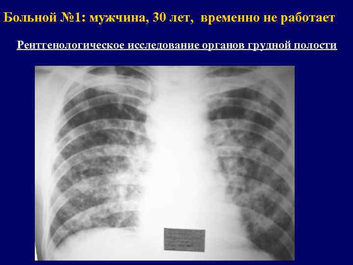 Больной № 1: мужчина, 30 лет, временно не работает Рентгенологическое исследование органов грудной полости