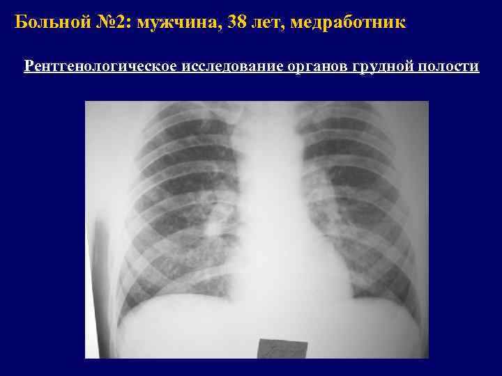 Больной № 2: мужчина, 38 лет, медработник Рентгенологическое исследование органов грудной полости 