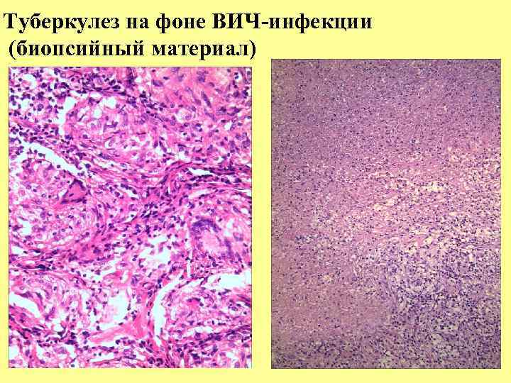 Туберкулез на фоне ВИЧ-инфекции (биопсийный материал) 
